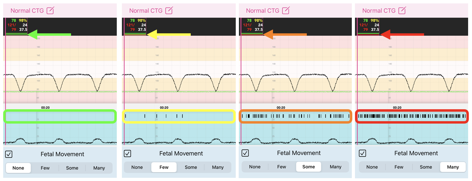 Facilitator_Maternal_Fetal_Movements.png