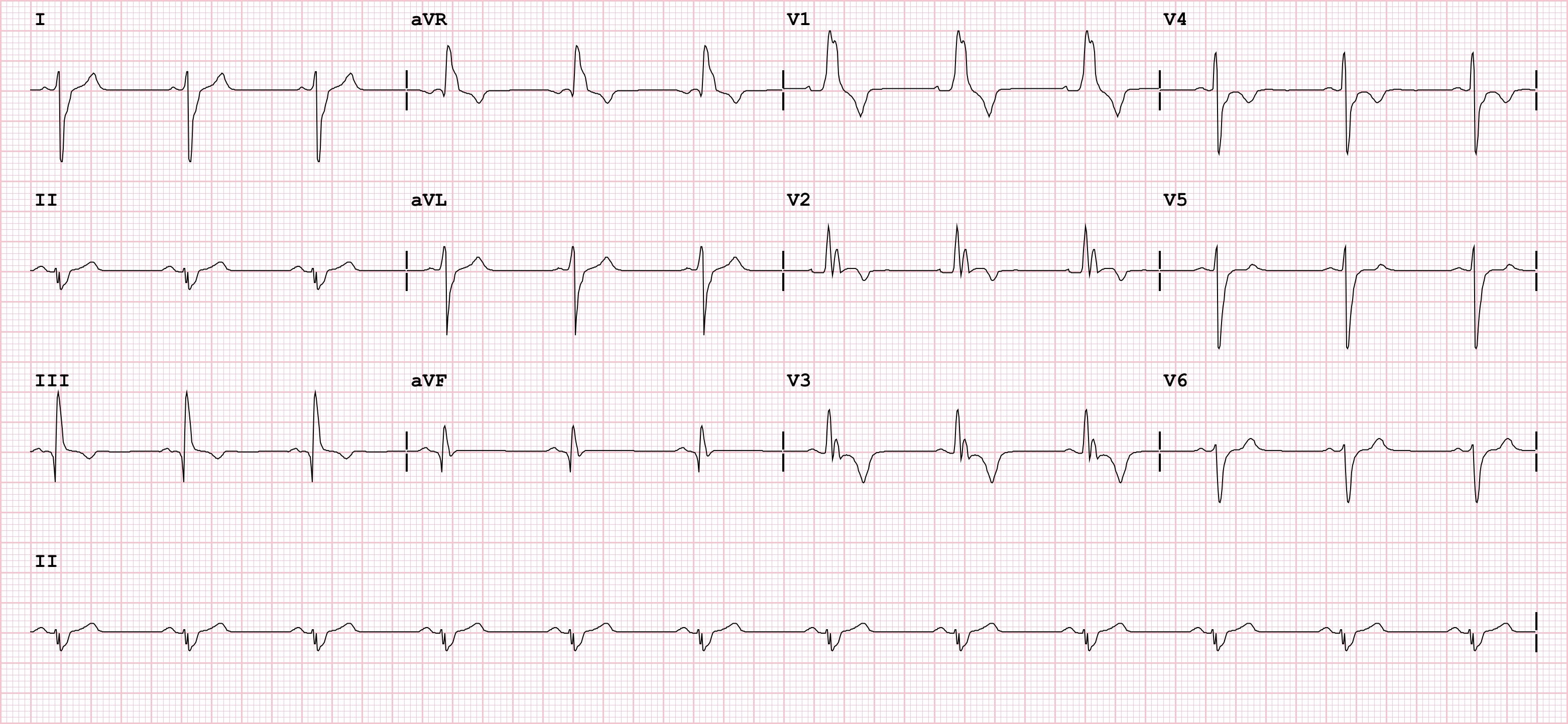 Pulmonary_Embolism_V10.3.jpeg