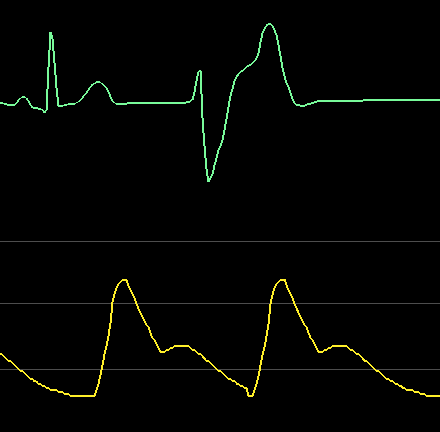 Ectopic_Normal_perfusion.PNG