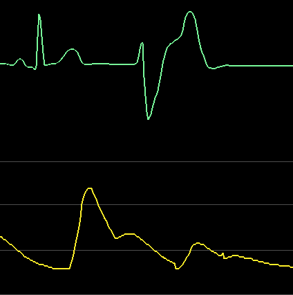 Ectopic_Poor_Perfusion.PNG
