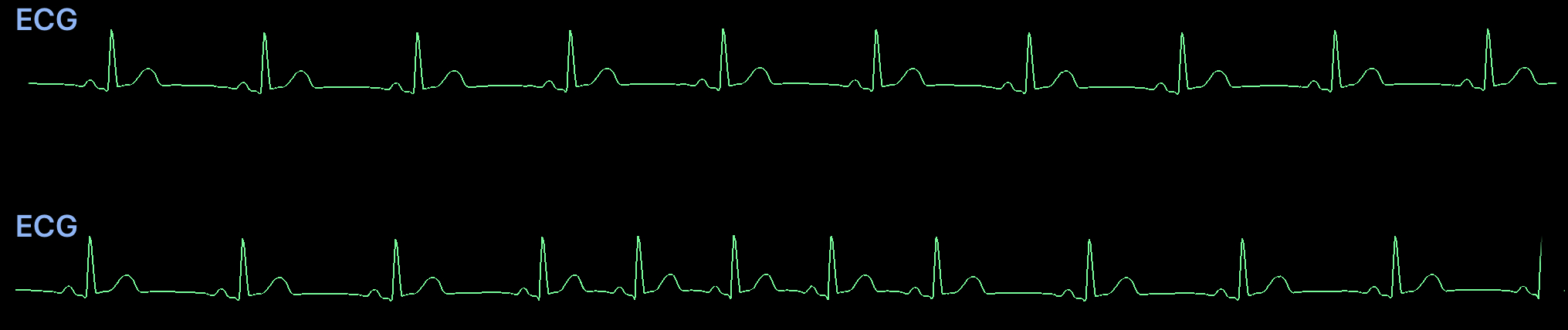 Sinus_Arrhythmia.jpeg